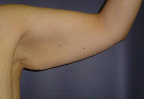 A1-arm.jpg