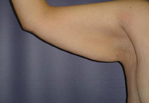 B1-arm.jpg