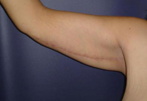 B2-arm.jpg