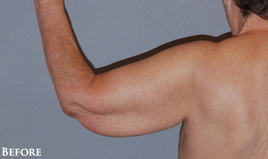 Brachio-DT-x4-BeforeLBack.jpg