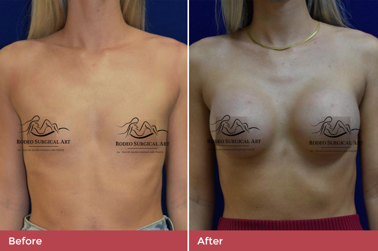 breast1-new-1.jpg