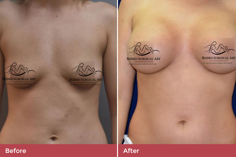breast2-new.jpg