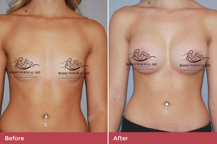 breast3-new.jpg