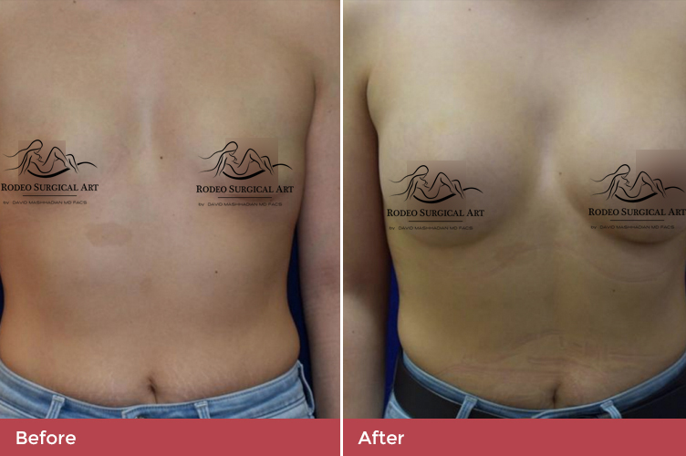 breast4-new.jpg