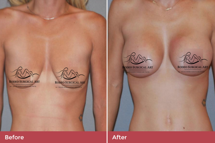 breast5-new.jpg