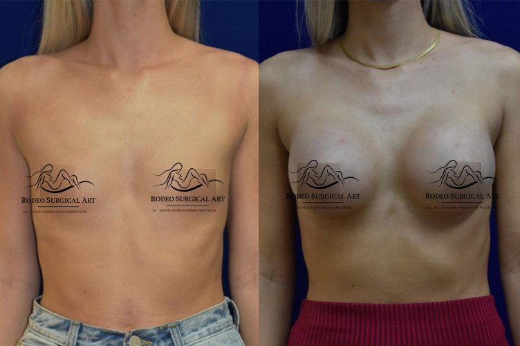 breast6-new.jpg