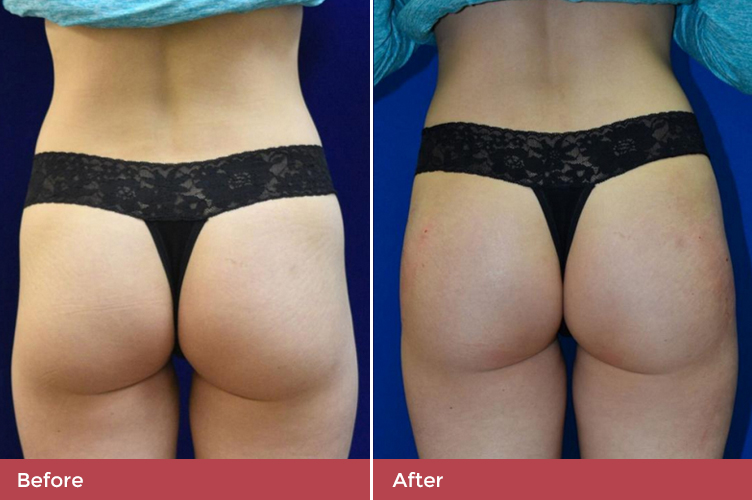 gallery-butt-lift-2-2.jpg