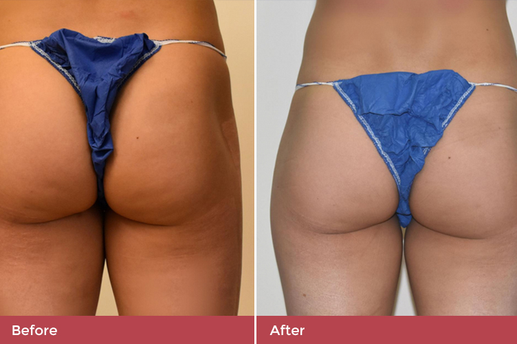 gallery-butt-lift-4.jpg